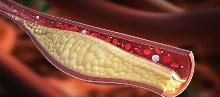 Calcium-Buildup-in-Young-Arteries-May-Signal-Heart-Attack-Risk-1440x810