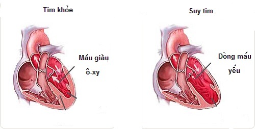 hoi-chung-suy-tim-nhung-kien-thuc-co-ban-dau-hieu-va-cach-phong-ngua-2