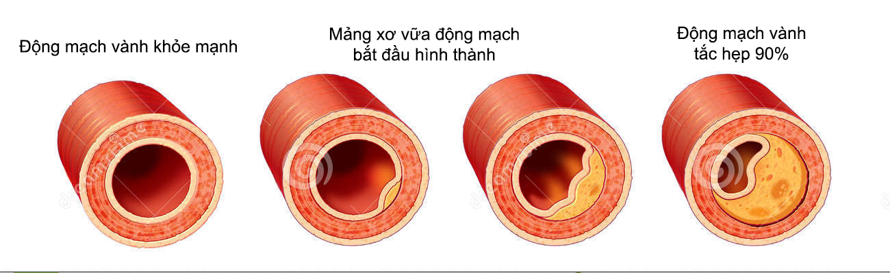 dat-stent-dong-mach-vanh-1