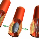 tong-quat-ve-thu-thuat-dat-stent-voi-benh-nhan-xo-vua-dong-mach