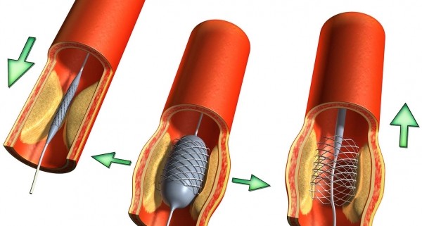 tong-quat-ve-thu-thuat-dat-stent-voi-benh-nhan-xo-vua-dong-mach