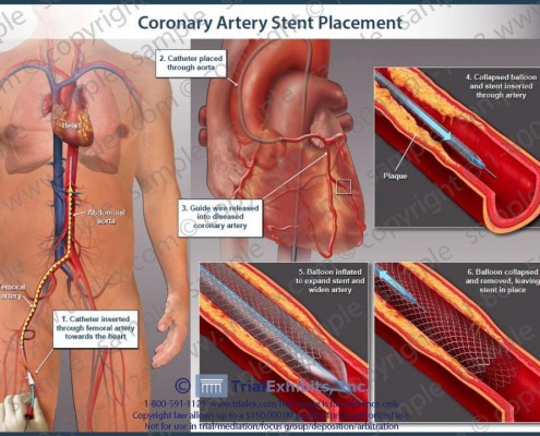 dat-stent-dong-mach-vanh-2