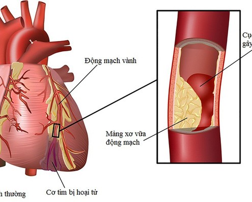 Benh-xo-vua-dong-mach-vanh-1