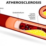 atherosclerosis-causes