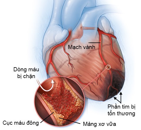 thieu-mau-co-tim-cuc-bo-va-nhung-dieu-ban-nen-biet-1