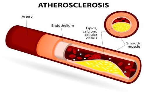 atherosclerosis-causes