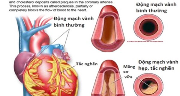 Bệnh động mạch vành-1