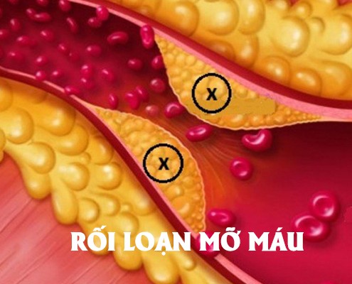 roi-loan-mo-mau-1